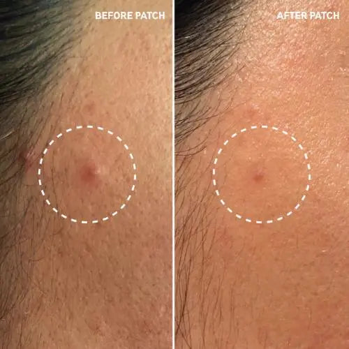 The Inkey List Hydrocolloid Invisible Pimple Patches