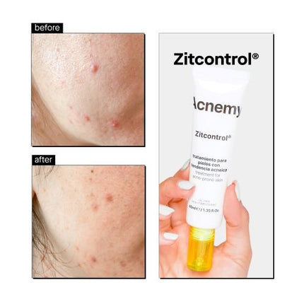 Acnemy Zitcontrol Treatment Cream